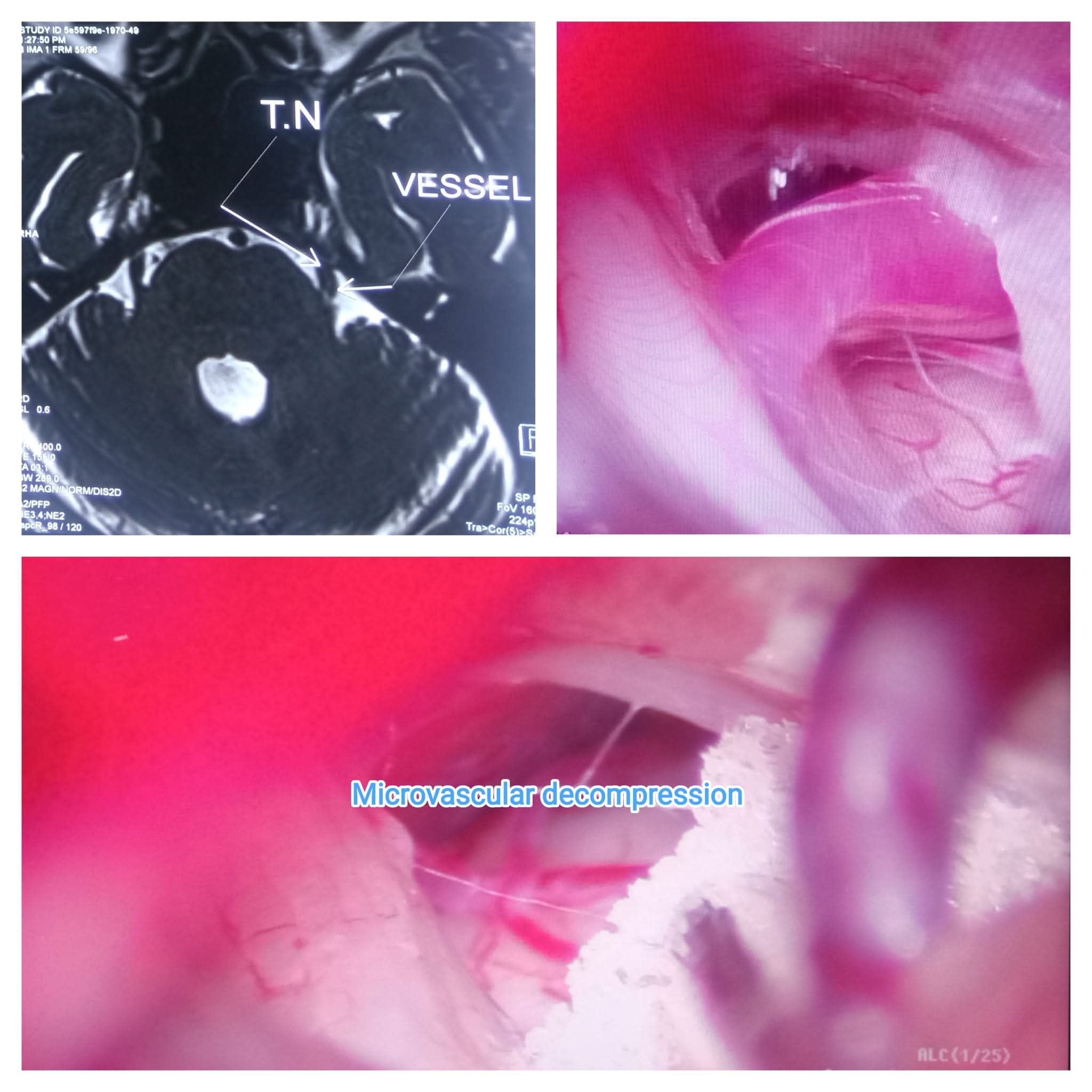 Trigeminal Neuralgia -Electric Shock like facial pain