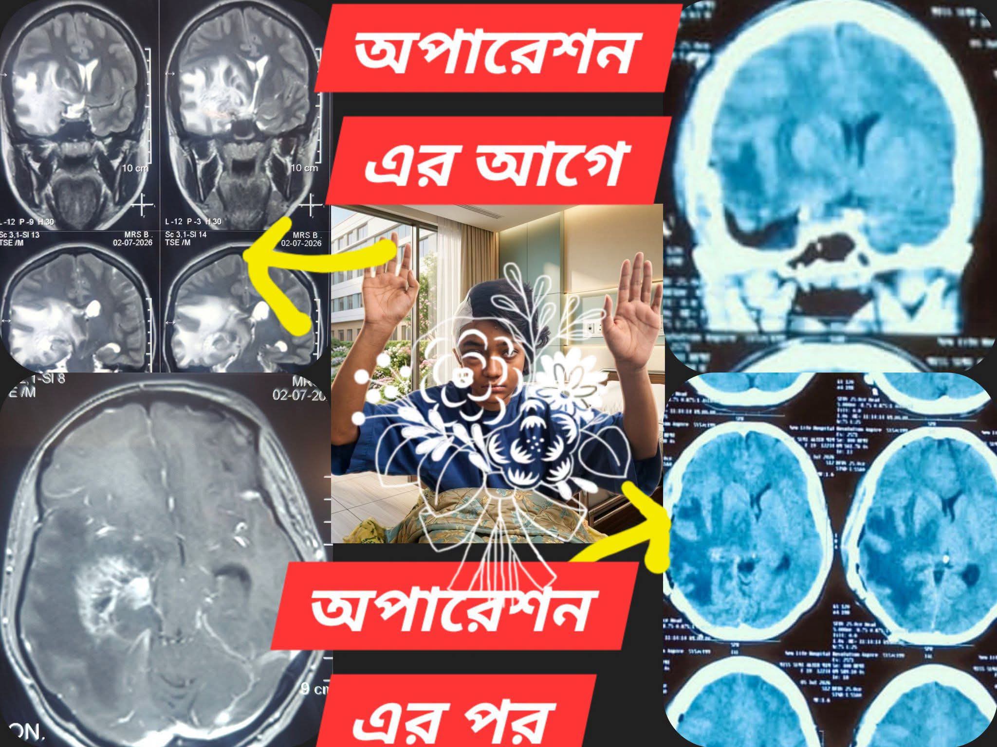 ব্রেইন টিউমার অপারেশন এর পর
