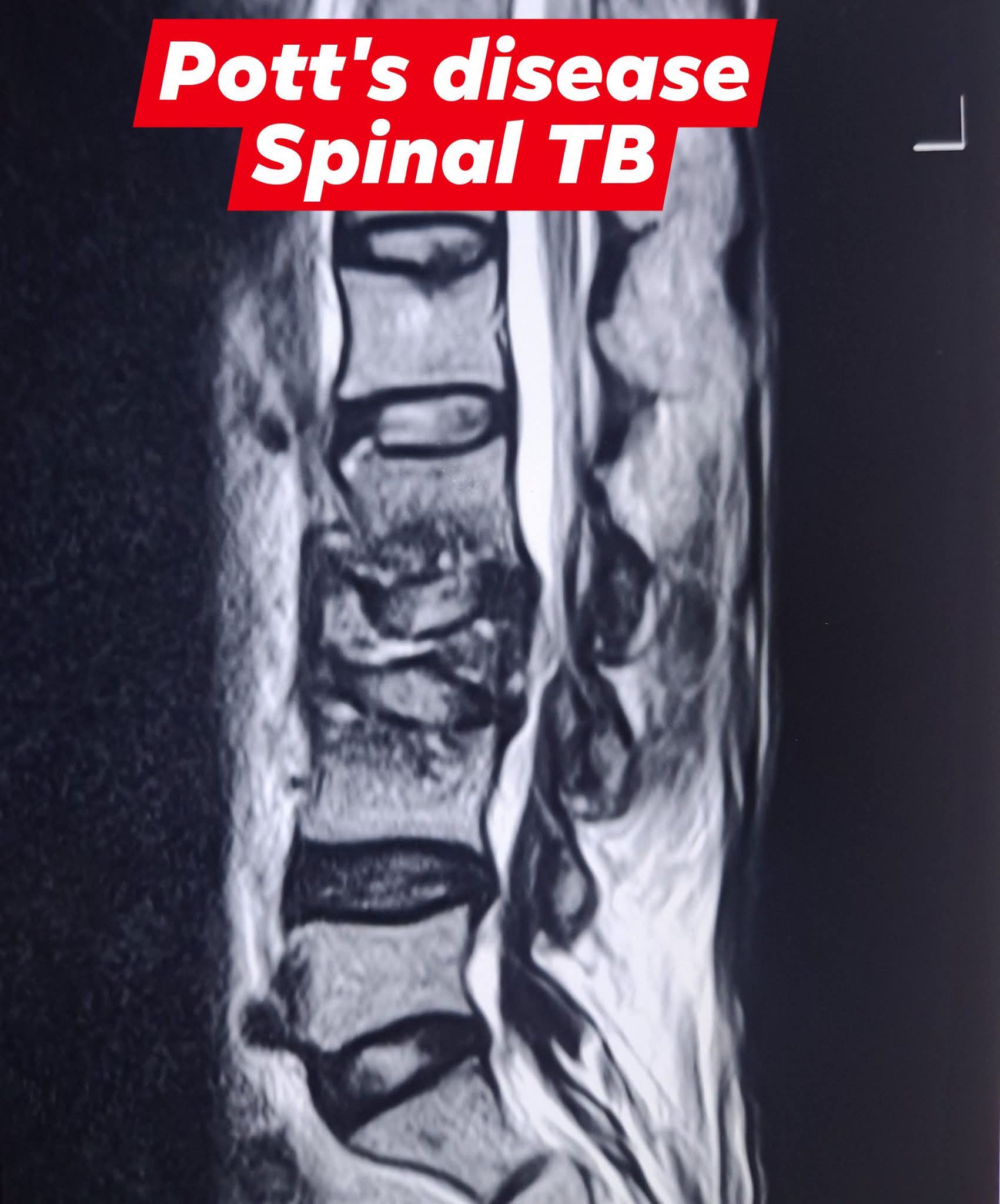 Spinal TB /Pott's disease #যক্ষ্মা